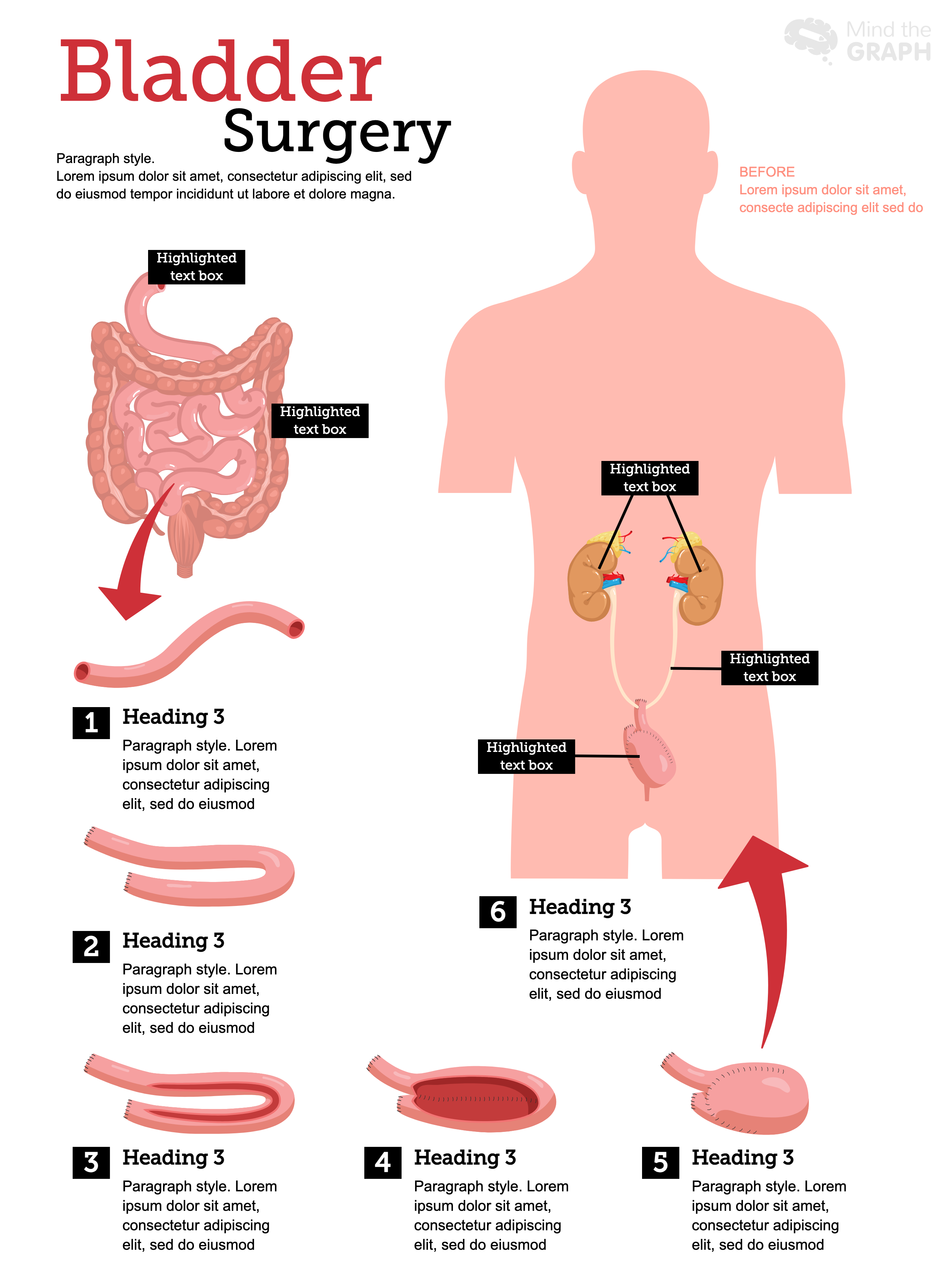 Posters template Bladder surgery